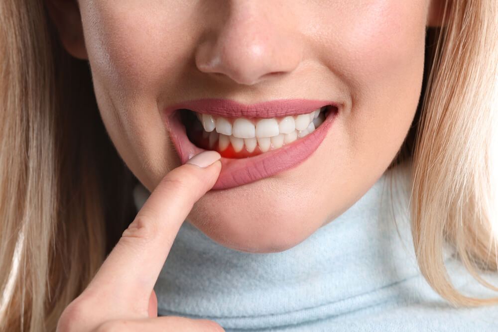 Woman using right hand finger to pull lower lip down and show swollen gum due to periodontitis
