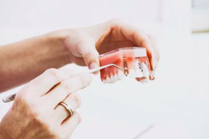 Holding model of teeth with dental implants