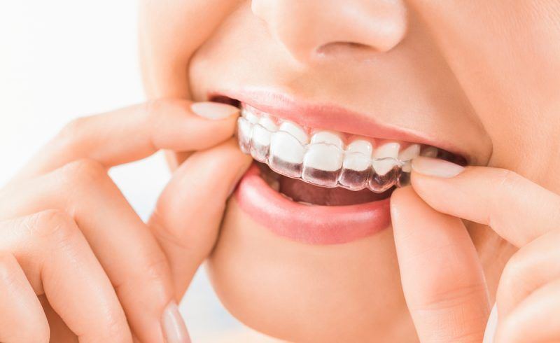 Placing Invisalign clear aligner over upper teeth