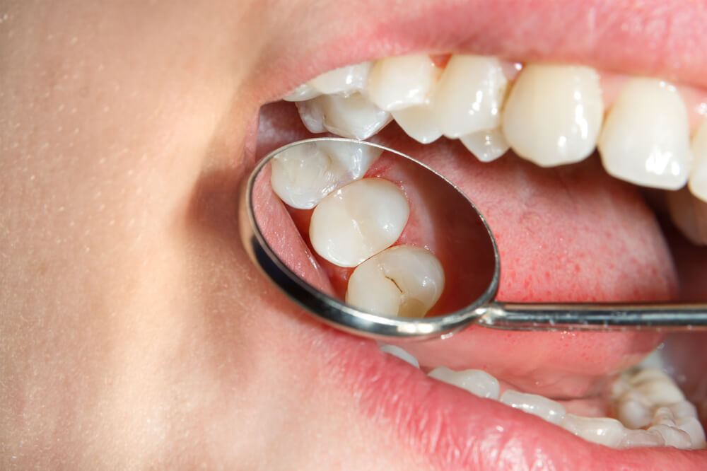 Using dental mirror to examine teeth with sealants